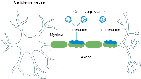 A diagram of a body’s central nervous system, including the brain and spinal cord and the damaged myelin around the nerve. Another image shows myelin, and how attacking cells cause inflammation.
